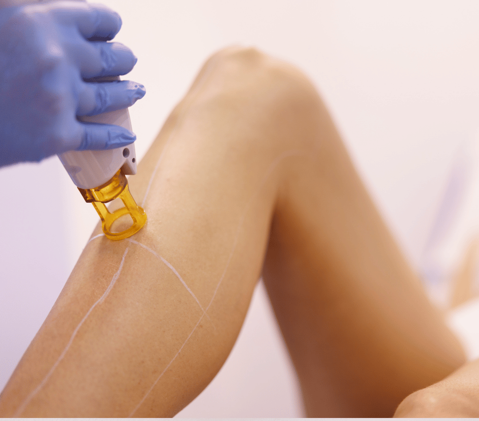 electrolysis and laser hair removal program in fort myers