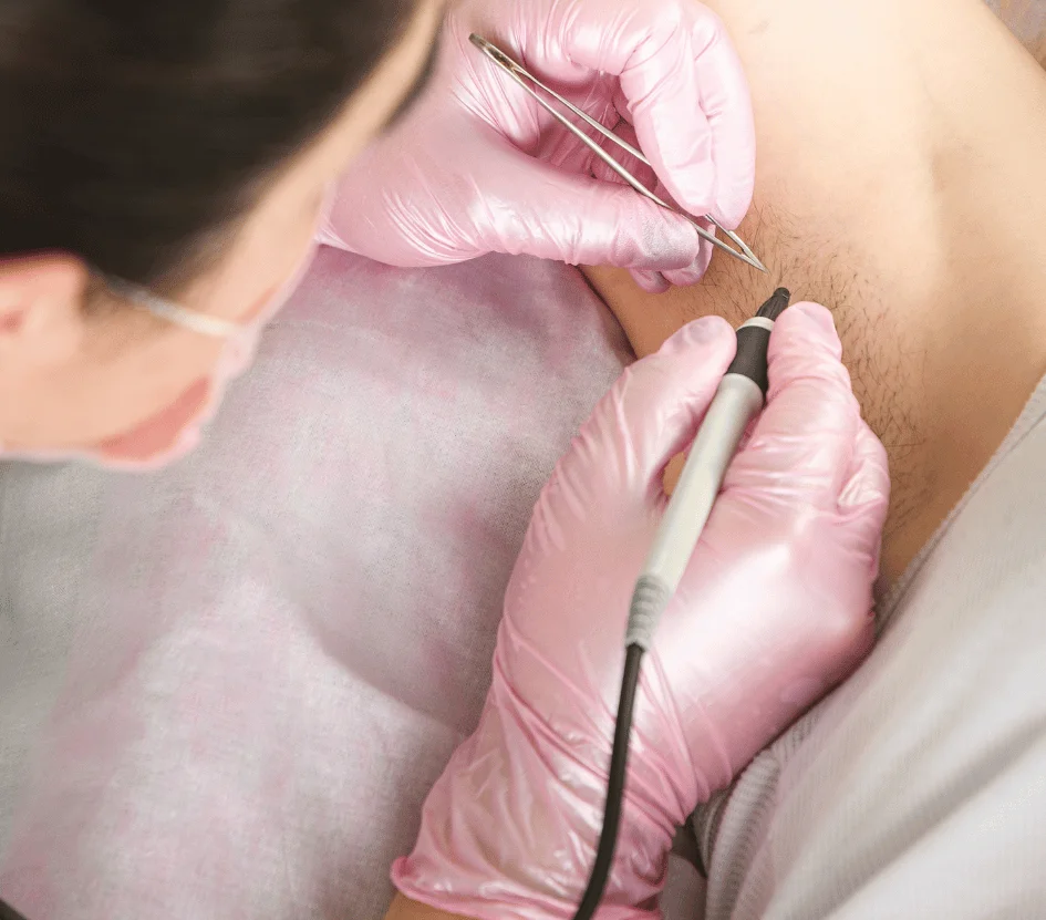 electrologist performing electrolysis | Florida Electrolysis Licensure Update