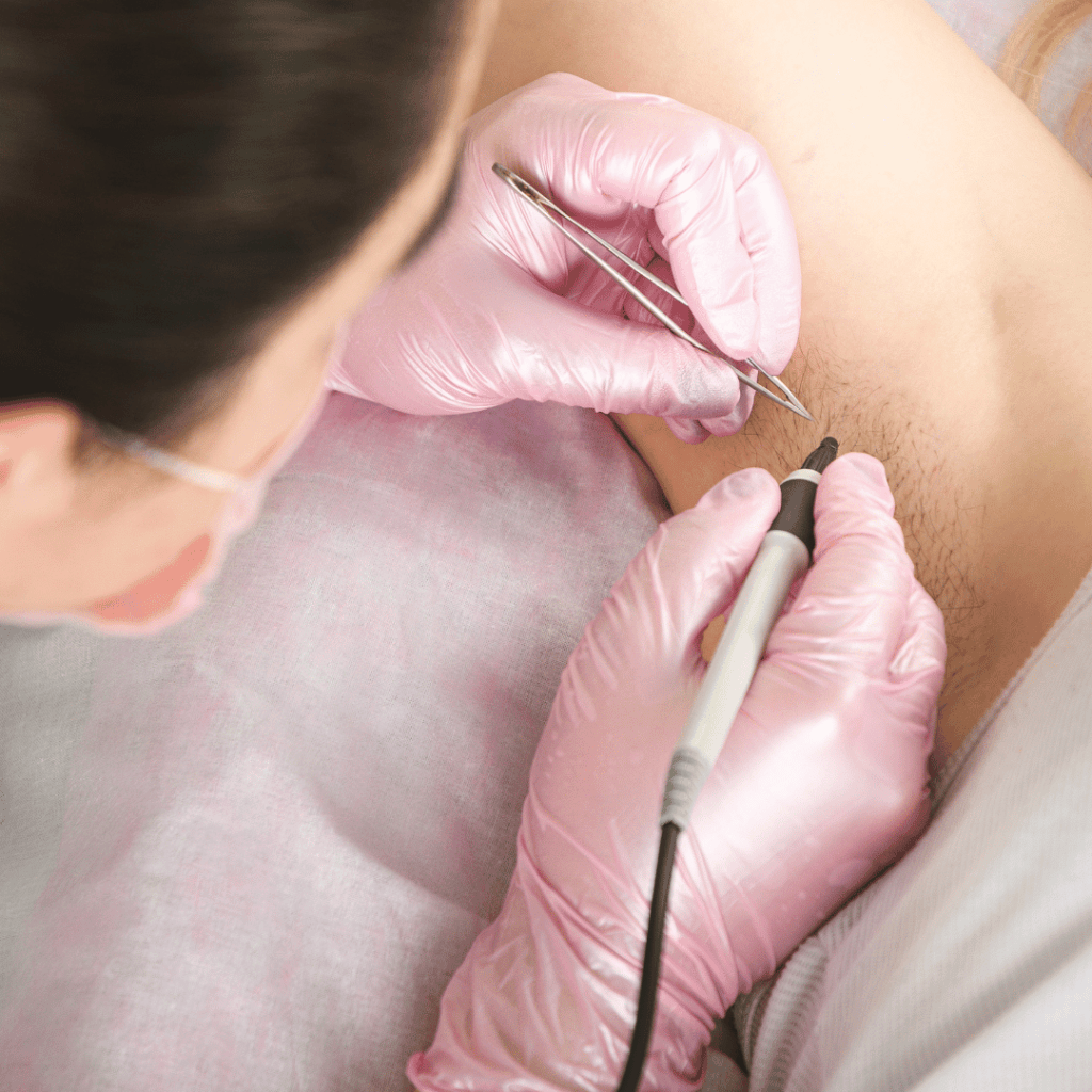 electrolysis and laser hair removal program in fort myers